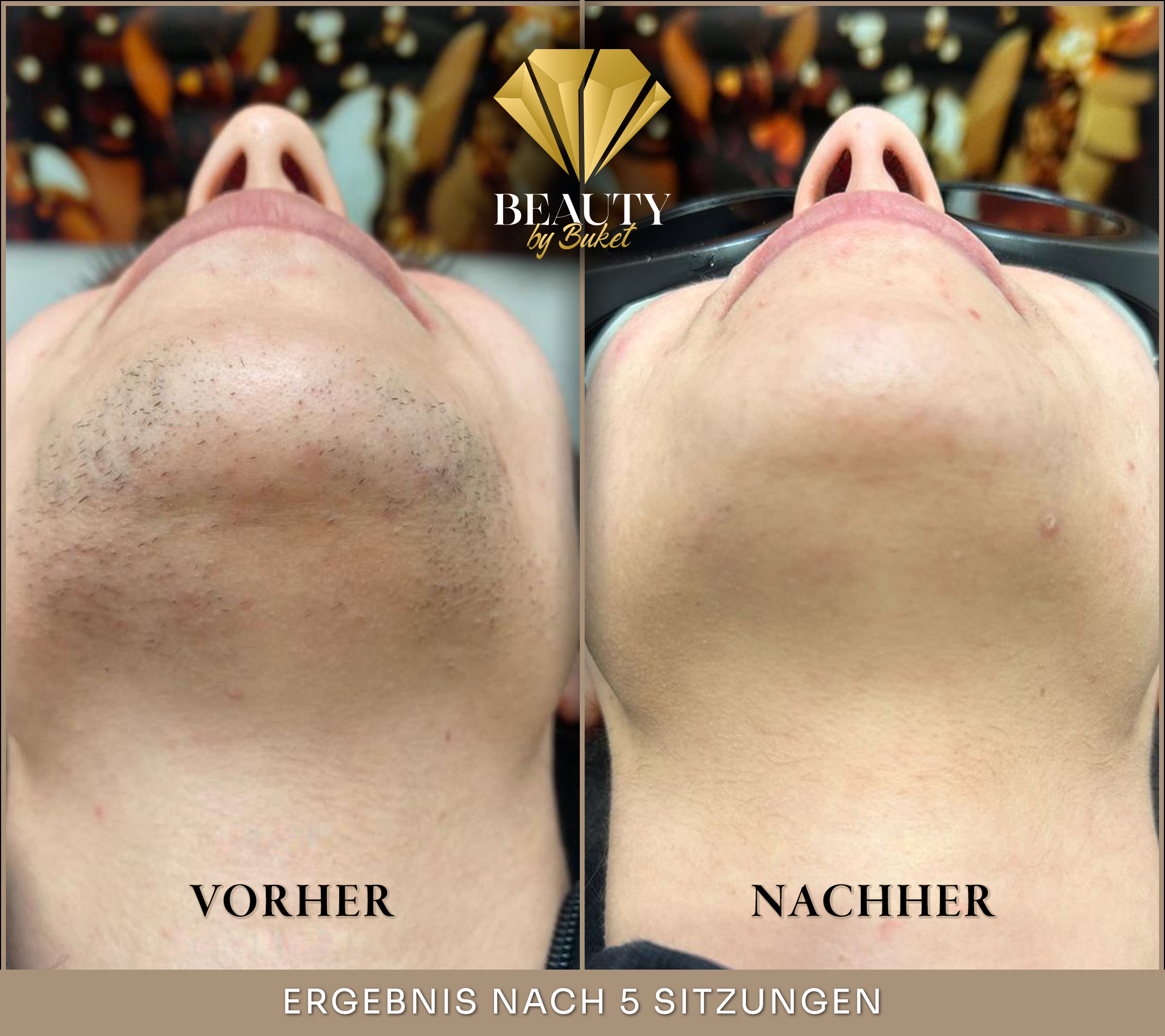 beauty-by-buket-diodenlaser-vorher-nachher-ergebis-nach-5-sitzung-in-mannheim