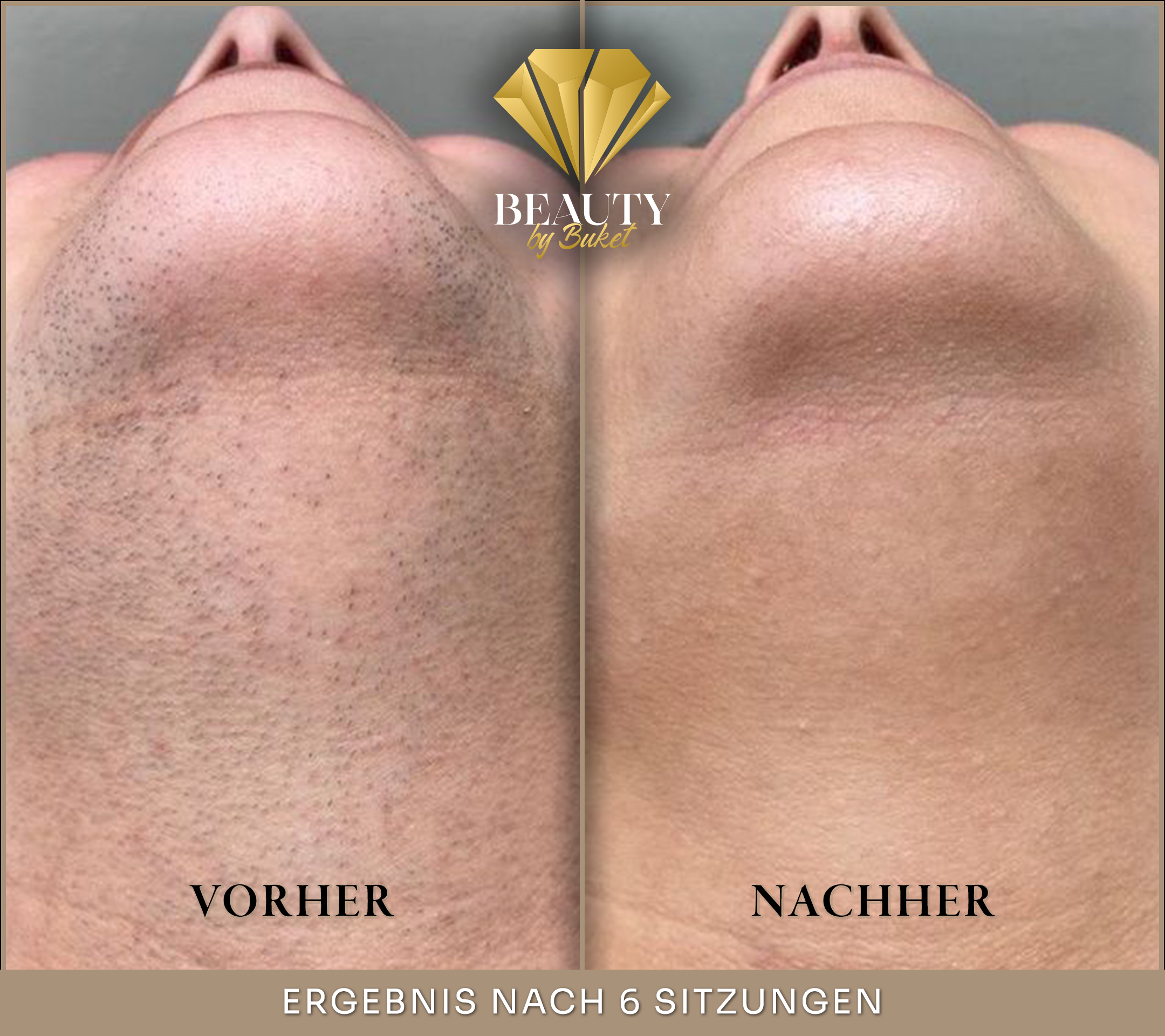 beauty-by-buket-diodenlaser-vorher-nachher-ergebis-nach-6-sitzung-in-mannheim